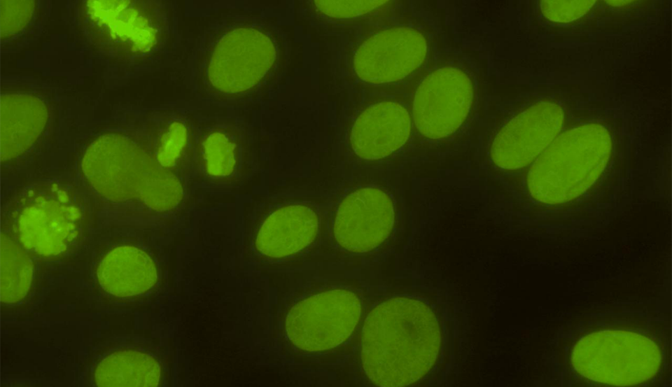 Pesquisa de autoanticorpos em células HEp-2 (FAN)