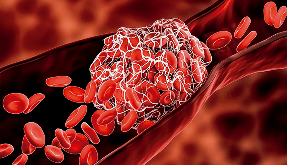 Trombofilias – O que é e como investigar?